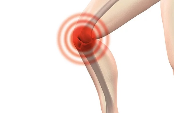 Artrosi del ginocchio: cos’è e rimedi naturali