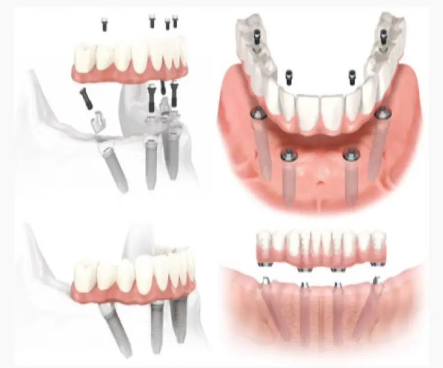 Materiali utilizzati nell'implantologia