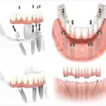 Materiali utilizzati nell'implantologia