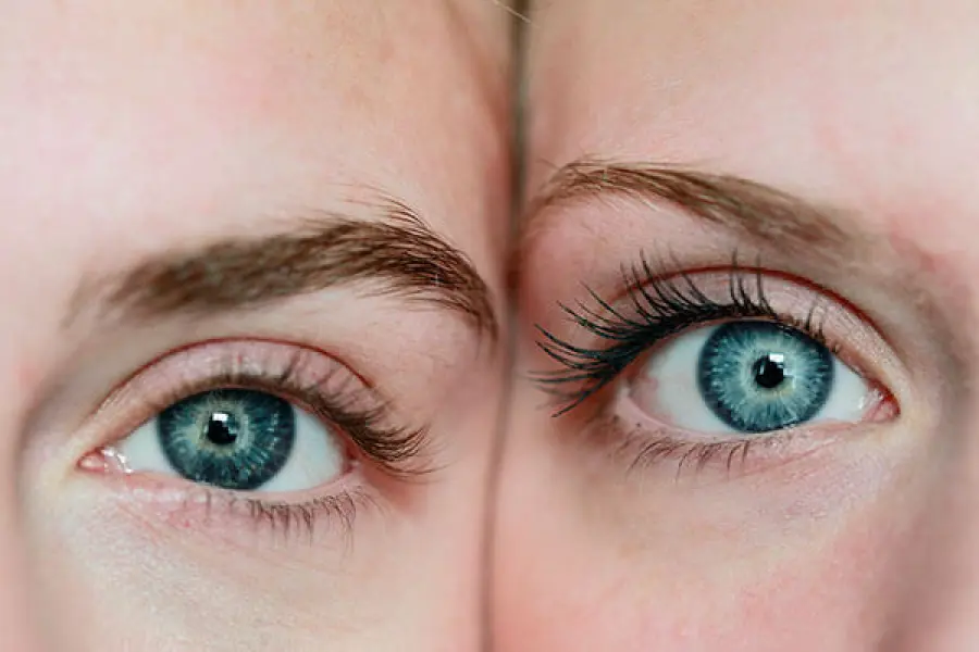 Lo Strabismo: cosa è, Come si cura