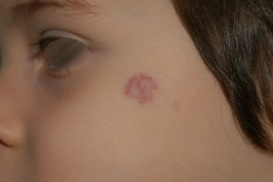 Voglia di Fragola: L'emangioma infantile