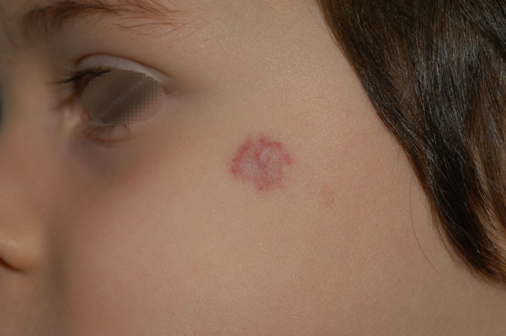 Voglia di Fragola: L'emangioma infantile