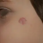 Voglia di Fragola: L'emangioma infantile