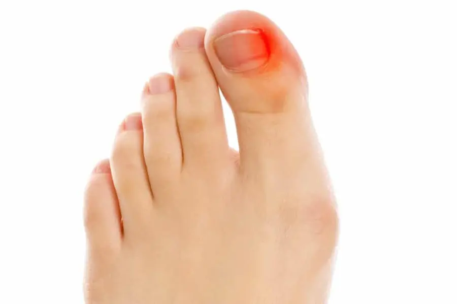 Alluce infiammato, cause e rimedi