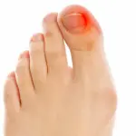 Alluce infiammato, cause e rimedi