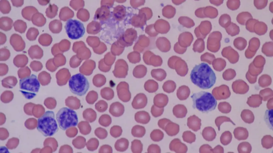 Cos'è la basofilia? Cause e sintomi