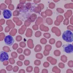 Cos'è la basofilia? Cause e sintomi