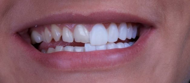 Come migliorare il tuo sorriso con le faccette dentali
